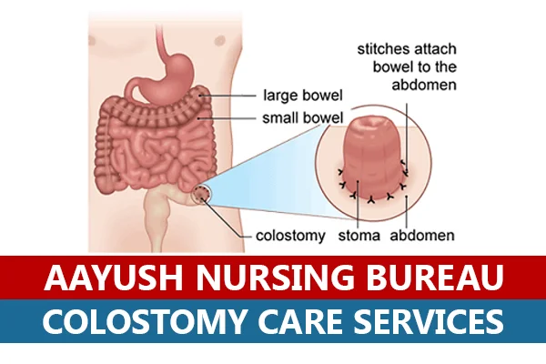 Colostomy Care Services